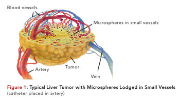 liver_tumor_w_microspheres